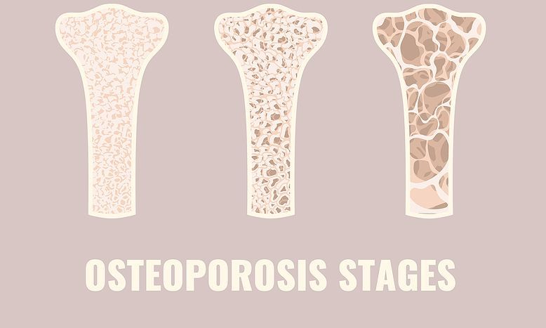 Πρόγραμμα ΔΩΡΕΑΝ ΜΕΤΡΗΣΗΣ της Οστικής Πυκνότητας για Πρόληψη της Οστεοπόρωσης.