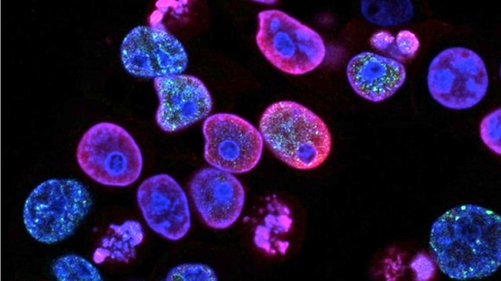 Τα επόμενα 10-15 χρόνια ο καρκίνος θα είναι μια χρόνια νόσος η οποία δεν θα σκοτώνει, εκτιμούν οι ειδικοί